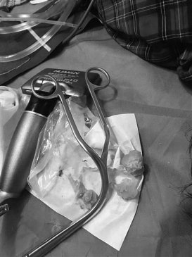 ����������ͻȻ�赹 ԭ�Ǳ�һö�̵��ƶ�ס����